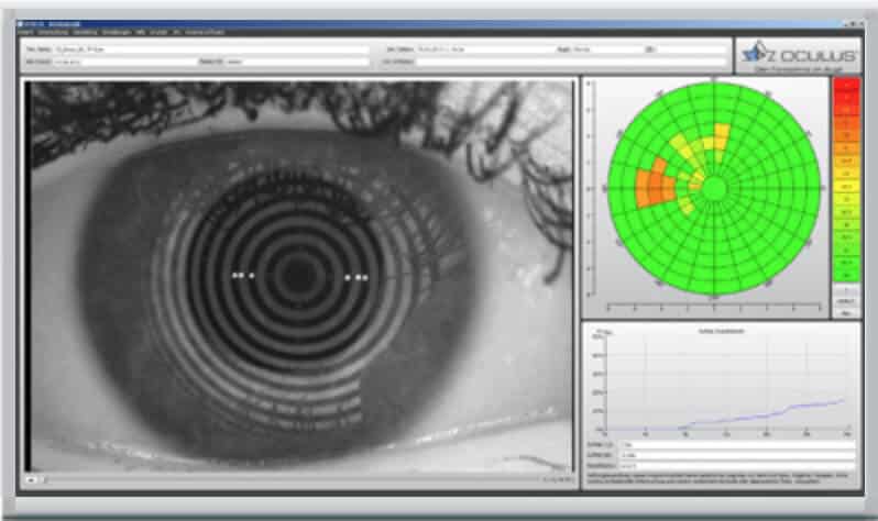 OCULUS Keratograph 5 04