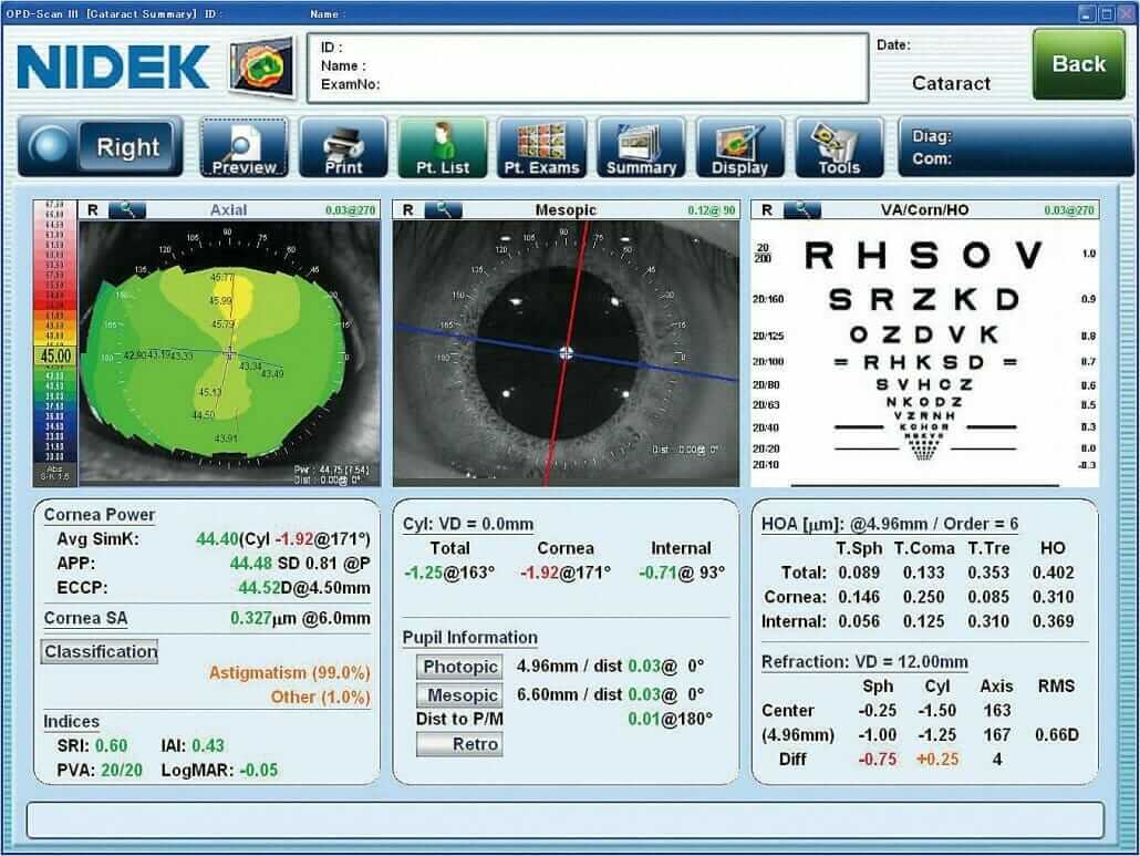 Nidek OPD Scan 3 02